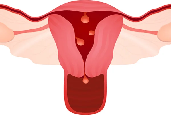 Menstrual Disorders